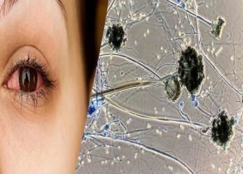 Kota में नहीं मिल रही ब्लैक फंगस की दवाइयां, मरीज परेशान