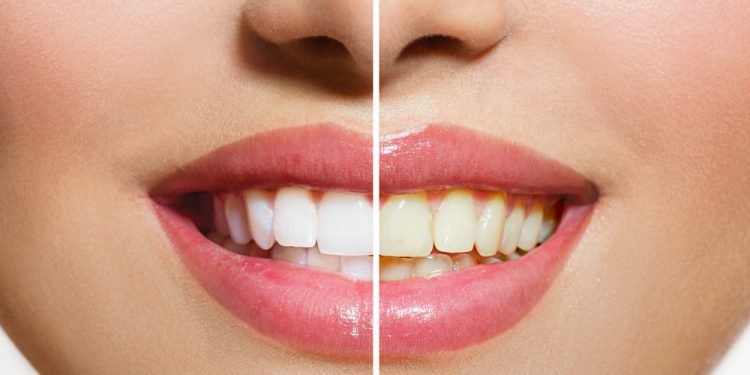 Dental Care Tips – पीले दातों कि समस्या को दूर करे इन टिप्स के जरिए