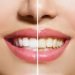 Dental Care Tips – पीले दातों कि समस्या को दूर करे इन टिप्स के जरिए