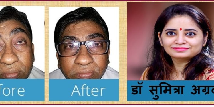 पैन किलर्स हमारी आँखों की पलकों