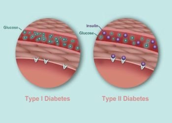 Type 2 Diabetes Turning into Type 1 Is it Possible