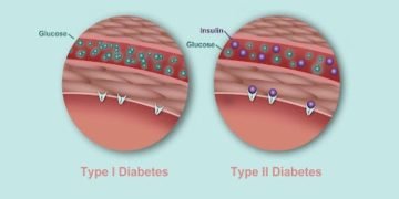 Type 2 Diabetes Turning into Type 1 Is it Possible