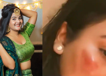 YouTuber Gungun Gupta Clears Up Facial Injury Rumors