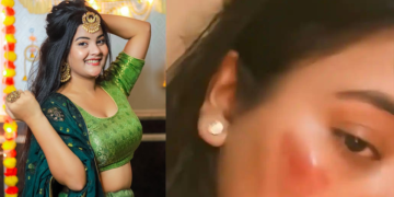 YouTuber Gungun Gupta Clears Up Facial Injury Rumors