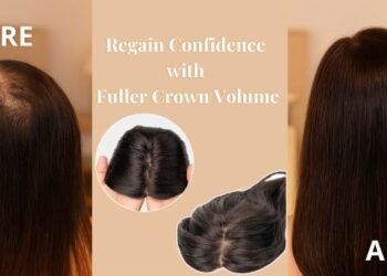 Hair Thinning at the Crown A Confident Solution Awaits