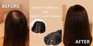 Hair Thinning at the Crown A Confident Solution Awaits