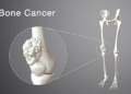 Understanding Bone Cancer