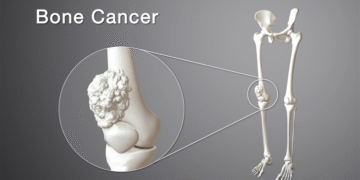 Understanding Bone Cancer