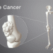 Understanding Bone Cancer