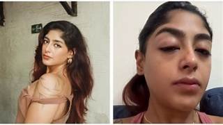 Splitsvilla Contestant Suffers Broken Tooth and Swollen Eyes Preet Singh Alleges Assault at a Club